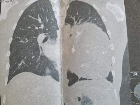 De tumor in de borstholte 