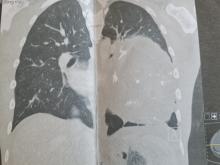 De tumor in de borstholte 